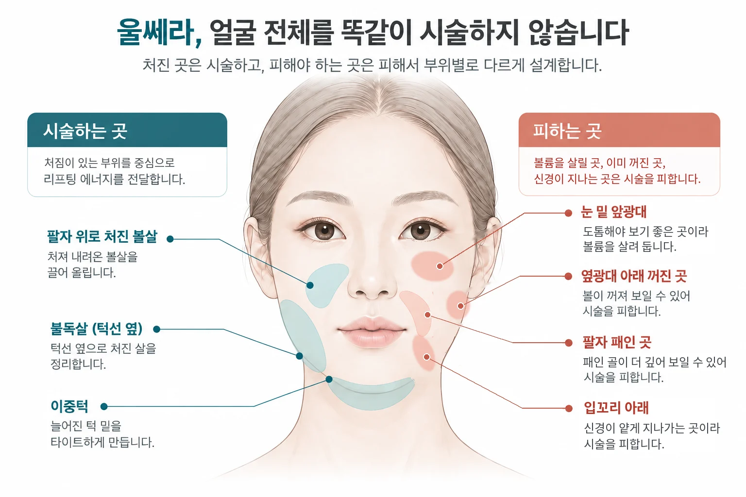 울쎄라 부위별 디자인 그림: 이중턱, 불독살, 팔자 위로 처진 볼살은 시술하고, 눈 밑 앞광대, 옆광대 아래 꺼진 곳, 팔자 패인 곳, 신경이 지나는 입꼬리 아래는 피하는 위치를 얼굴 위에 표시